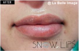 リップホワイトニングセッション後2